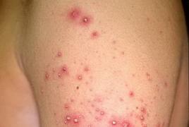 Инфекционные заболевания кожи, симптомы и лечение